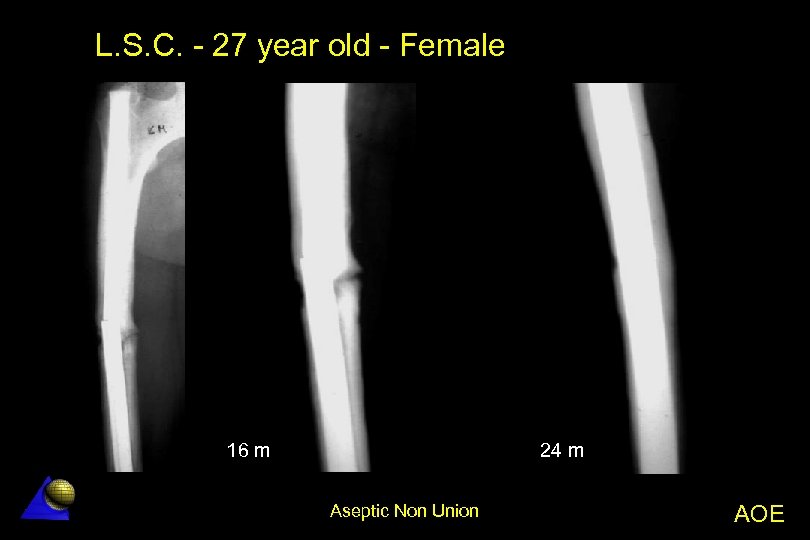 L. S. C. - 27 year old - Female 16 m 24 m Aseptic