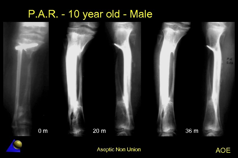 P. A. R. - 10 year old - Male 0 m 20 m Aseptic