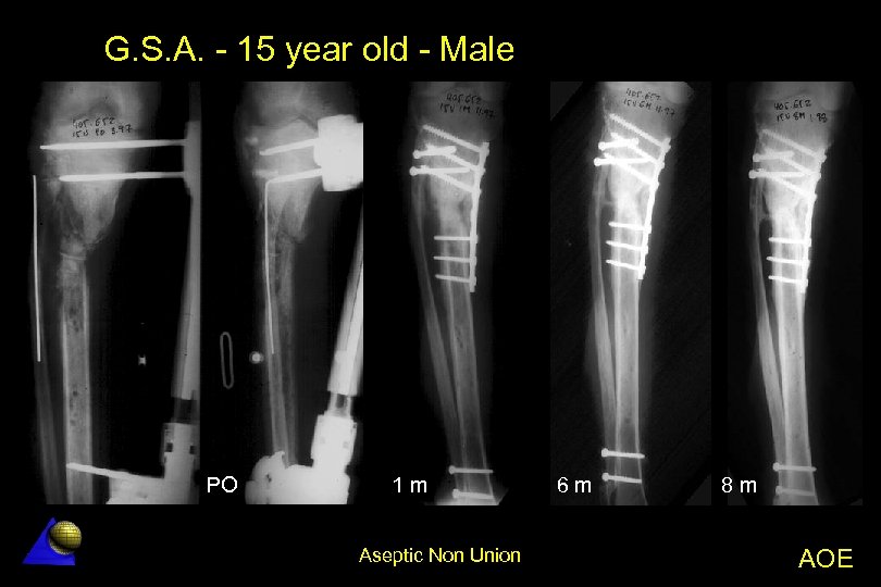 G. S. A. - 15 year old - Male PO 1 m Aseptic Non