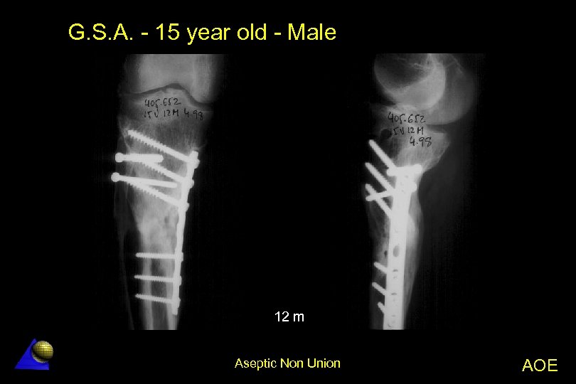 G. S. A. - 15 year old - Male 12 m Aseptic Non Union