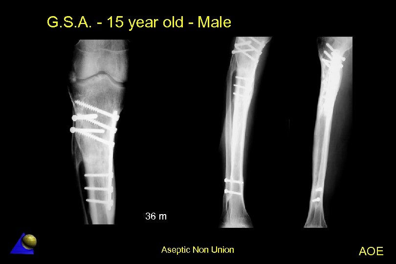 G. S. A. - 15 year old - Male 36 m Aseptic Non Union