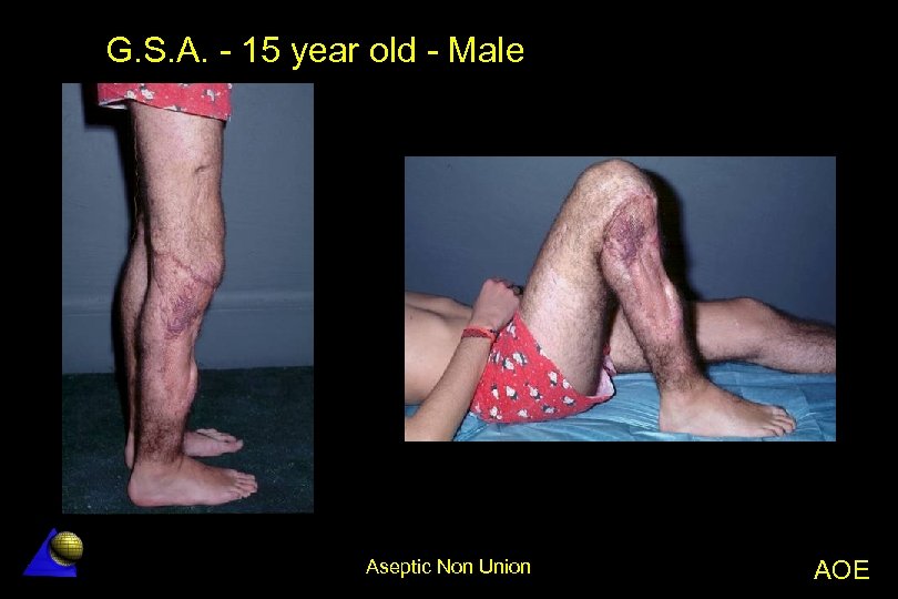 G. S. A. - 15 year old - Male Aseptic Non Union AOE 