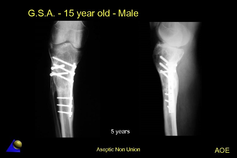 G. S. A. - 15 year old - Male 5 years Aseptic Non Union