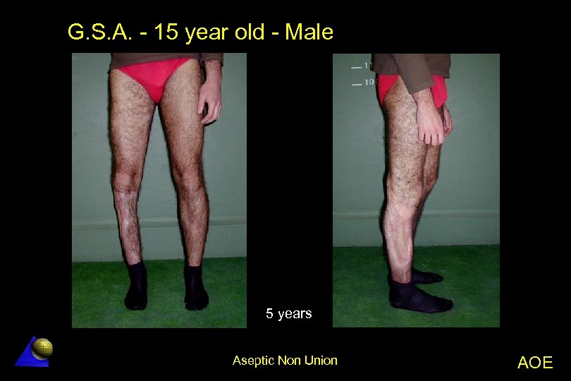 G. S. A. - 15 year old - Male 5 years Aseptic Non Union