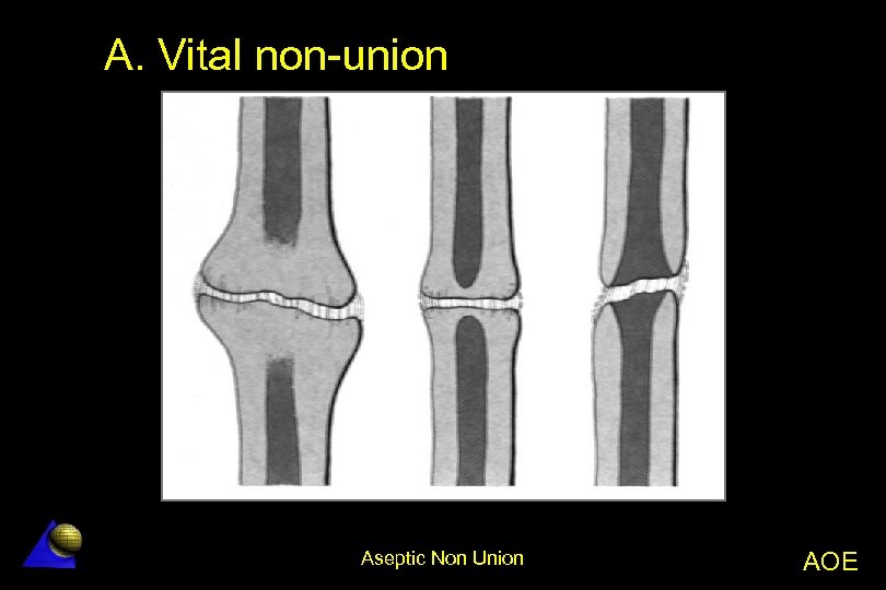 A. Vital non-union Aseptic Non Union AOE 