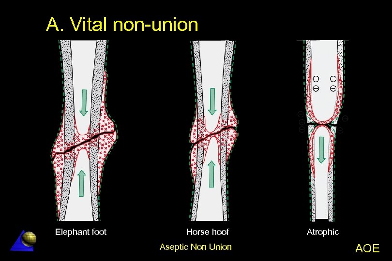 A. Vital non-union Elephant foot Horse hoof Aseptic Non Union Atrophic AOE 