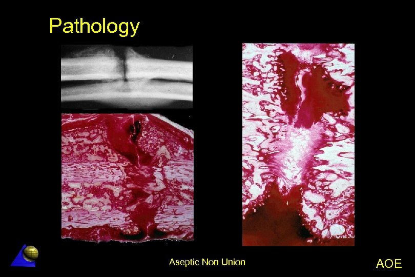 Pathology Aseptic Non Union AOE 