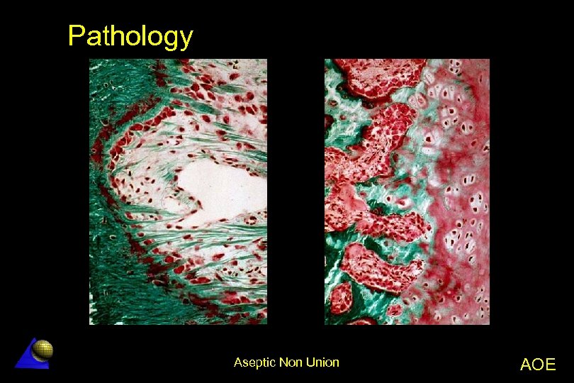 Pathology Aseptic Non Union AOE 