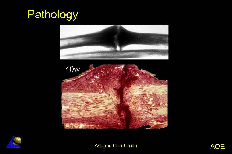 Pathology Aseptic Non Union AOE 