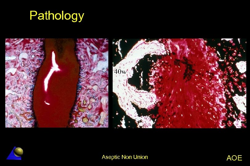 Pathology Aseptic Non Union AOE 