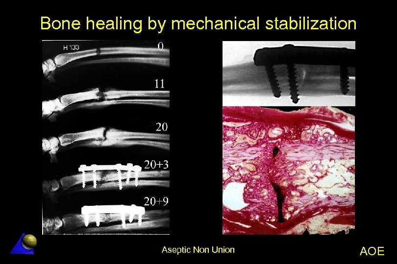 Bone healing by mechanical stabilization Aseptic Non Union AOE 