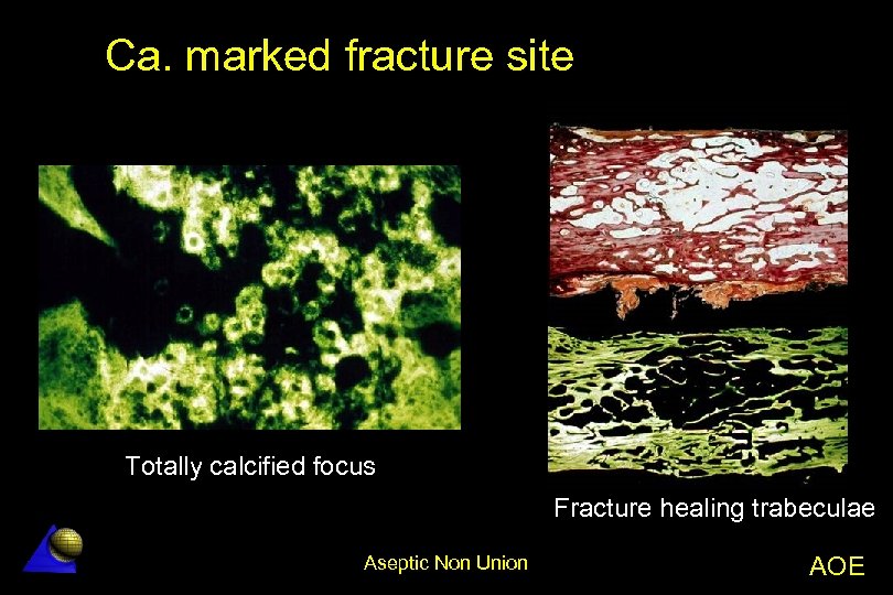 Ca. marked fracture site Totally calcified focus Fracture healing trabeculae Aseptic Non Union AOE