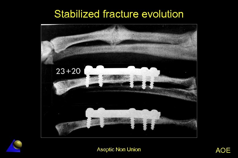 Stabilized fracture evolution Aseptic Non Union AOE 