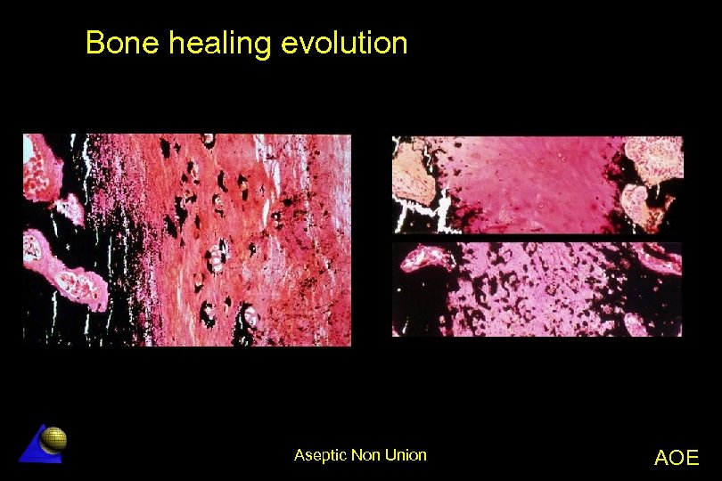 Bone healing evolution Aseptic Non Union AOE 