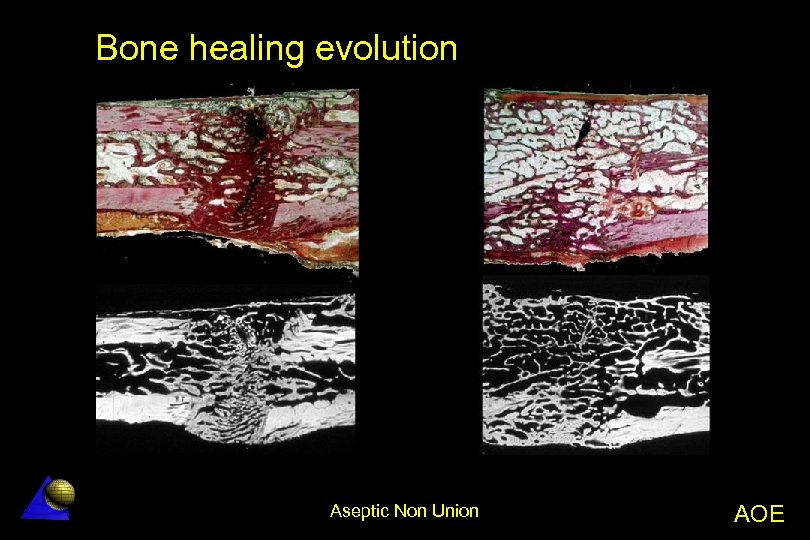 Bone healing evolution Aseptic Non Union AOE 