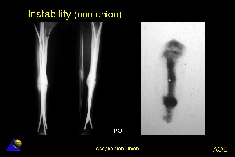 Instability (non-union) PO Aseptic Non Union AOE 