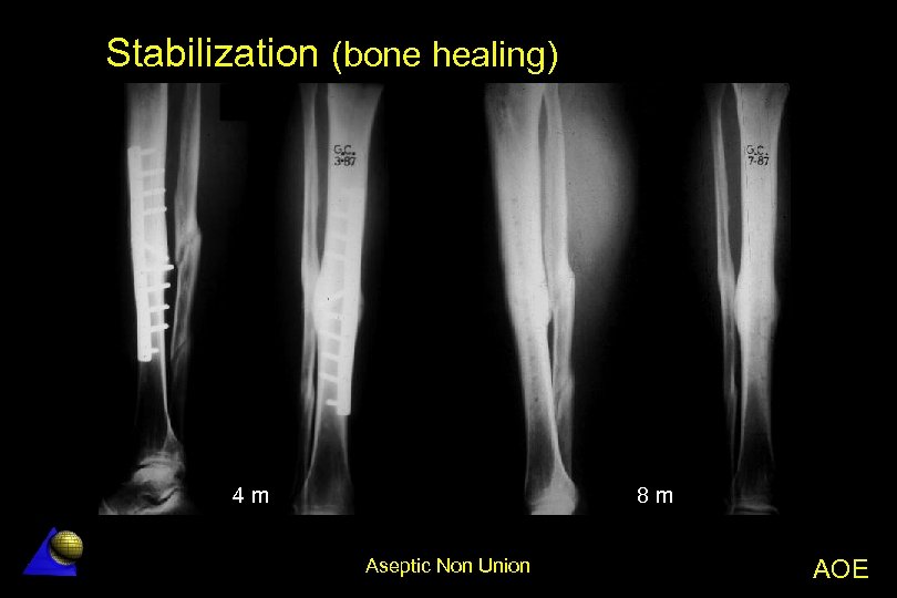 Stabilization (bone healing) 8 m 4 m Aseptic Non Union AOE 