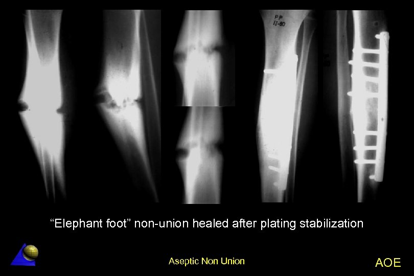 “Elephant foot” non-union healed after plating stabilization Aseptic Non Union AOE 