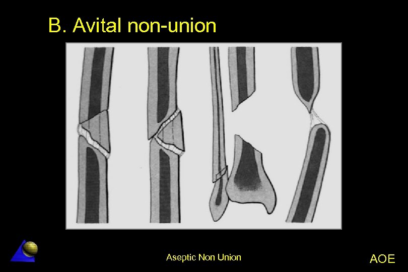 B. Avital non-union Aseptic Non Union AOE 