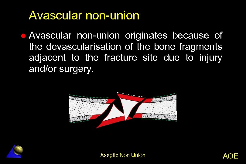 Avascular non-union l Avascular non-union originates because of the devascularisation of the bone fragments