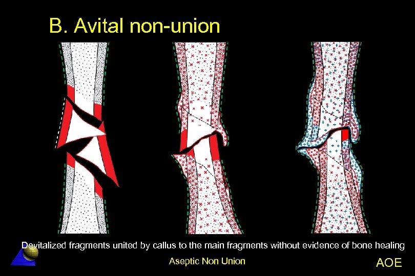 B. Avital non-union Devitalized fragments united by callus to the main fragments without evidence