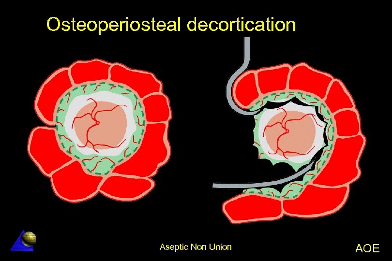 Osteoperiosteal decortication Aseptic Non Union AOE 