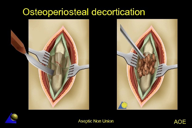 Osteoperiosteal decortication Aseptic Non Union AOE 