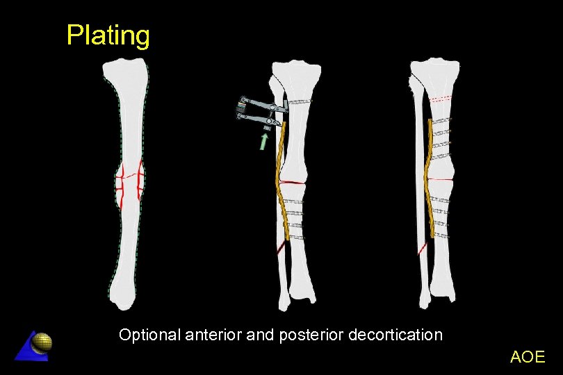 Aseptic NonUnion Aseptic Non Union AOE AO