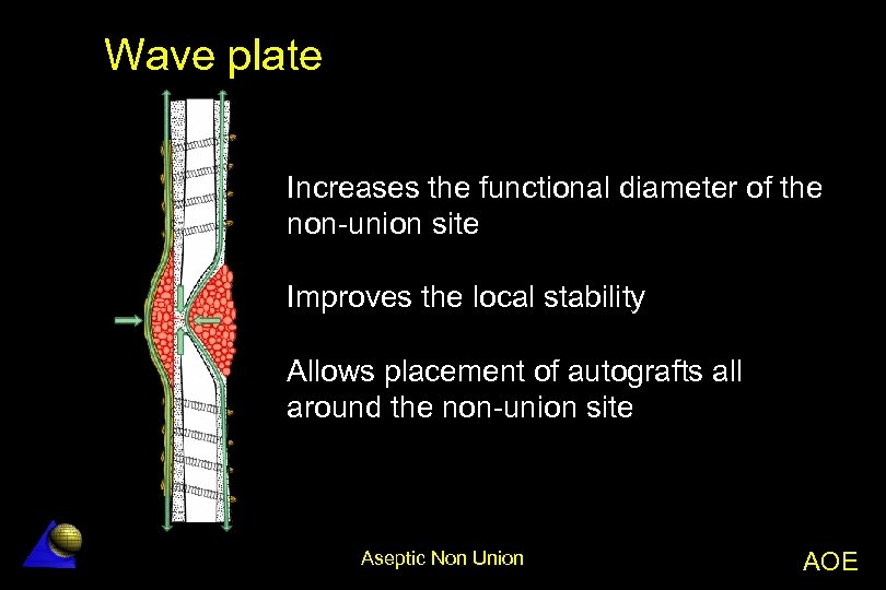 Wave plate Increases the functional diameter of the non-union site Improves the local stability