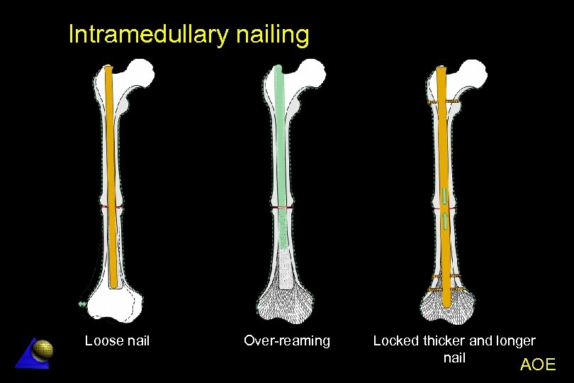 Aseptic NonUnion Aseptic Non Union AOE AO