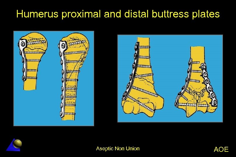 Humerus proximal and distal buttress plates Aseptic Non Union AOE 