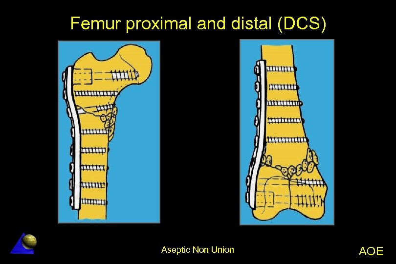 Femur proximal and distal (DCS) Aseptic Non Union AOE 