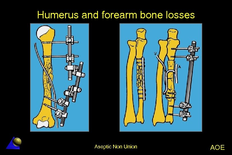 Aseptic NonUnion Aseptic Non Union AOE AO