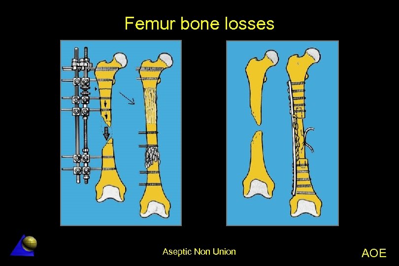 Femur bone losses Aseptic Non Union AOE 