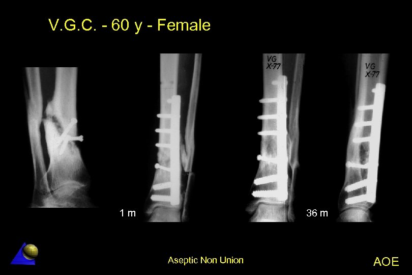 V. G. C. - 60 y - Female 1 m 36 m Aseptic Non