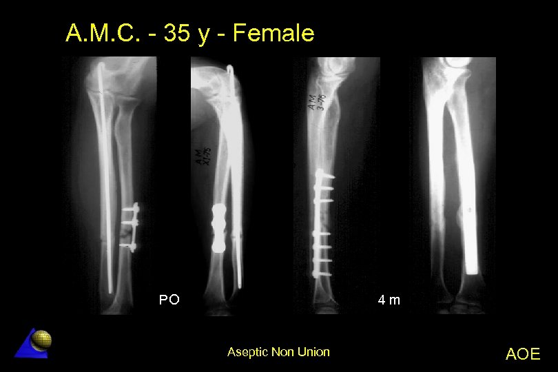 A. M. C. - 35 y - Female 4 m PO Aseptic Non Union