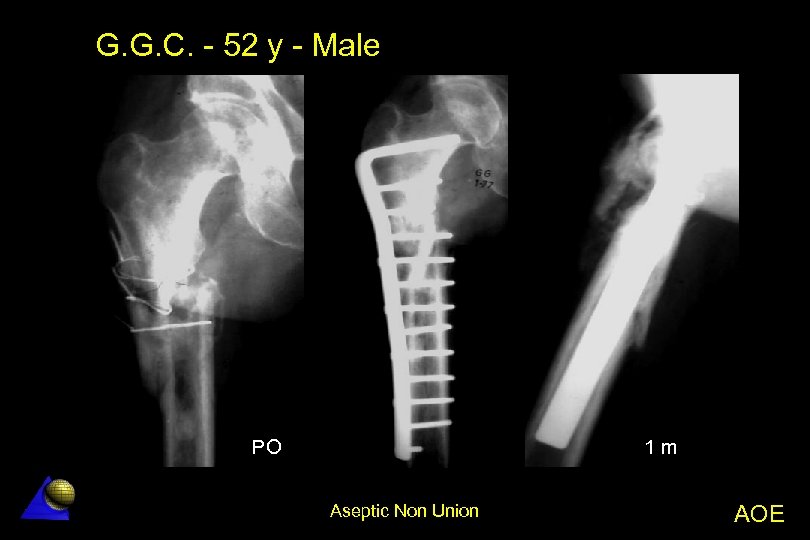 G. G. C. - 52 y - Male PO 1 m Aseptic Non Union