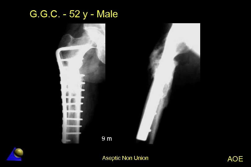 G. G. C. - 52 y - Male 9 m Aseptic Non Union AOE