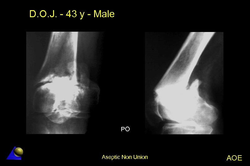 D. O. J. - 43 y - Male PO Aseptic Non Union AOE 