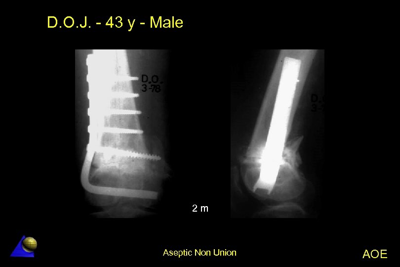 D. O. J. - 43 y - Male 2 m Aseptic Non Union AOE