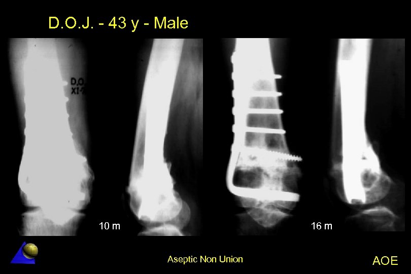 D. O. J. - 43 y - Male 10 m 16 m Aseptic Non