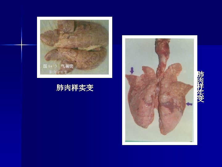 肺肉样实变 肺 肉 样 实 变 