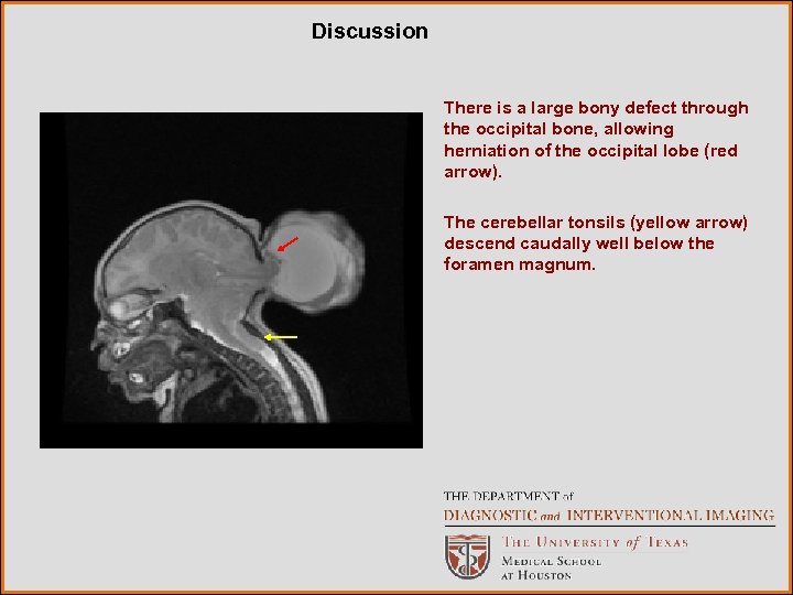 Discussion There is a large bony defect through the occipital bone, allowing herniation of