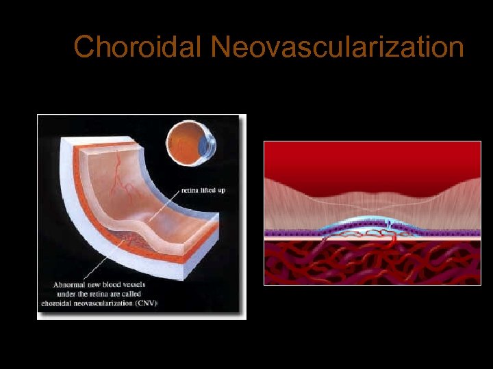 Choroidal Neovascularization 