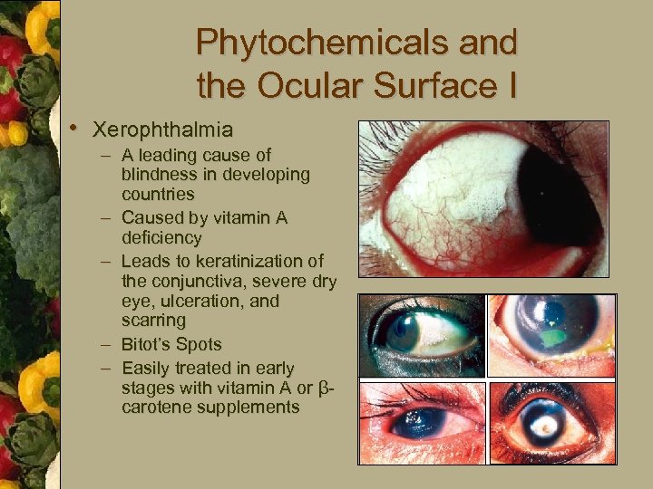 Phytochemicals and the Ocular Surface I • Xerophthalmia – A leading cause of blindness