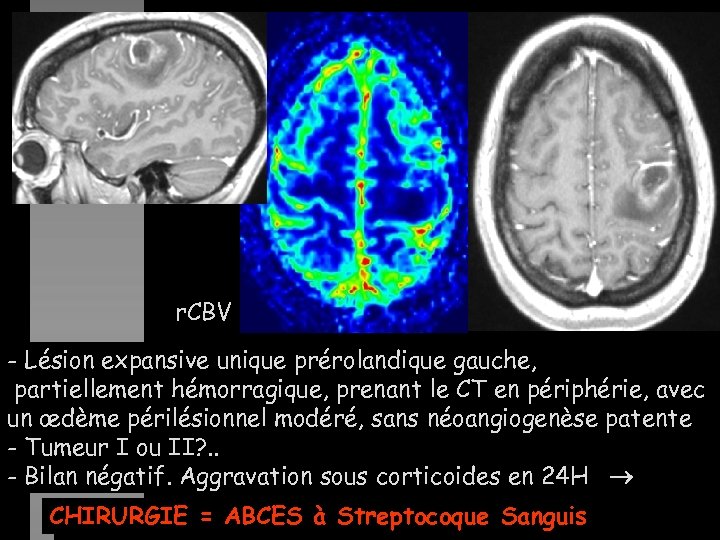 r. CBV - Lésion expansive unique prérolandique gauche, partiellement hémorragique, prenant le CT en
