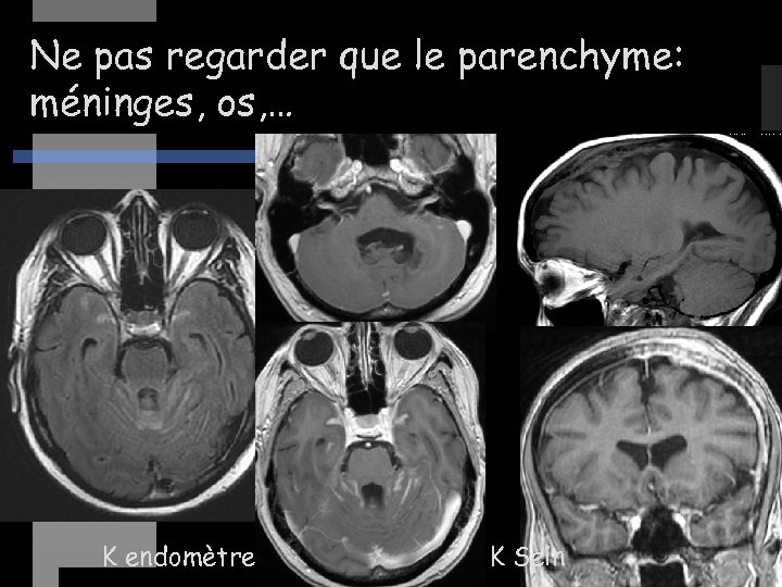 Ne pas regarder que le parenchyme: méninges, os, … K endomètre K Sein 