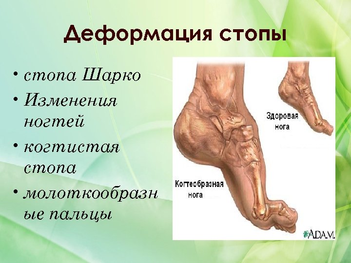 Деформация стопы • стопа Шарко • Изменения ногтей • когтистая стопа • молоткообразн ые