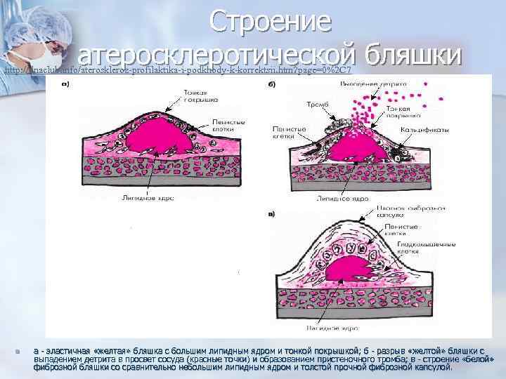 Строение атеросклеротической бляшки http: //dnaclub. info/ateroskleroz-profilaktika-i-podkhody-k-korrektsii. htm? page=0%2 C 7 n а - эластичная