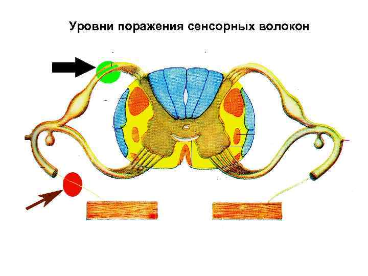 Уровни поражения сенсорных волокон 